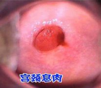 宮頸息肉注意事項(xiàng)